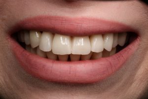 caso clínico de éxito en estética dental