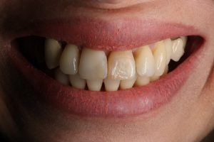 Caso clínico de carillas dentales